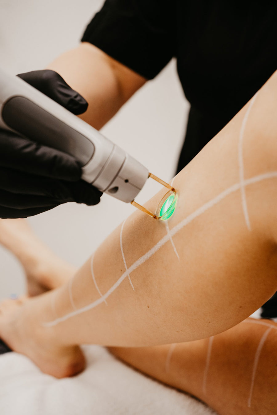 Feet + Toes Laser Hair Removal Services