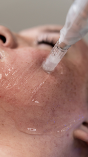 RF Microneedling Face + Neck