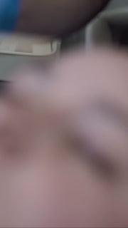 RF Microneedling Face + Neck